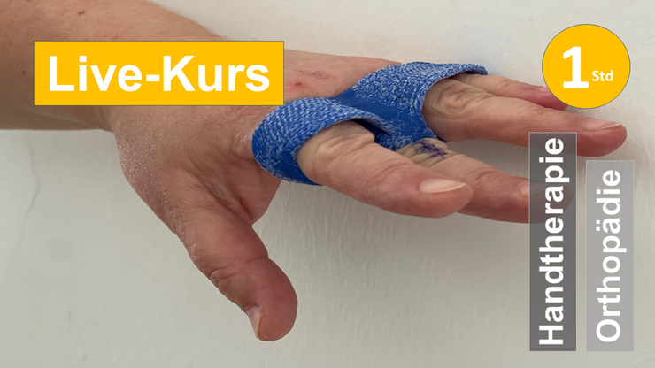 Sie sehen eine gestreckte Hand mit relative Motion Schiene als Assoziation zum Webseminar zu Strecksehnenverletzung für Ergotherapie + Physiotherapie in der Rehabilitation von Handverletzungen, Handtherapie in Klinik + Praxis